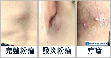 身體釘子|疔瘡是什麼？「疔子」會自己好嗎？與痘痘、粉瘤4大。